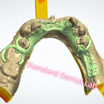 kaufen Metallrahmen-Design Laserdruck Gusschrom-Teilprothese Ni Be Free on-line-Fertigung