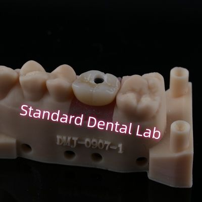 kaufen Einheitliche Schraube für das Implantatkronen on-line-Fertigung