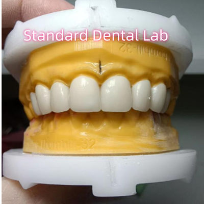 kaufen Ivoclar Zirkonia Kronen Veneers Hohe Durchsichtigkeit Ästhetisch on-line-Fertigung