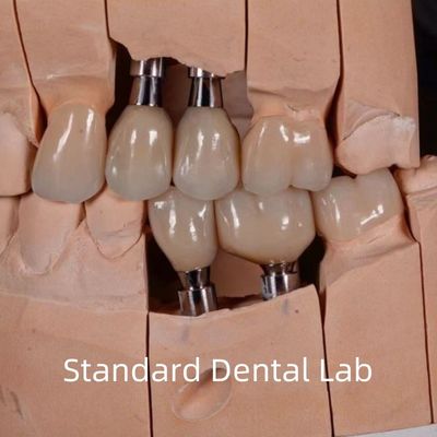 kaufen Natürlich aussehende ästhetische Schraube mit Zirkonia-Implantatkrone on-line-Fertigung
