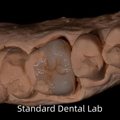 kaufen Durchsichtigkeit Emax Zirkonia Zahn Inlay Onlay Krone zur Wiederherstellung der natürlichen Hohlraumform on-line-Fertigung