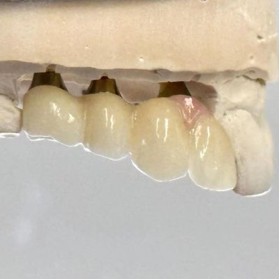 kaufen Porzellan Zirkonia Zement Behaltene Schraube Implantat Hexagonalen Kopfform für individuelle Fit Ästhetik on-line-Fertigung