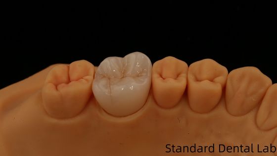 kaufen Noritake Porzellan Vollkontur Zirkonia Krone kundenspezifischer Vita Schatten für ästhetische digitale Zahnrestaurierung durch Zahnlabor on-line-Fertigung