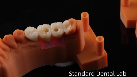 kaufen Schraubenhalte Zahnimplantatkrone mit PFZ-Porzellan-Schicht Zirkonia 5-Jahres-Garantie und 3D-Druckmodell on-line-Fertigung