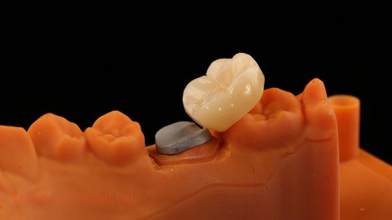 kaufen Hohe Ästhetik Vollkontur Zirkonia Krone mit Metall Post Kern 5 Jahre Garantie und bessere Techniker von SDL Dental Lab on-line-Fertigung