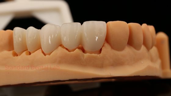 kaufen Hoch-Ästhetische Vorderzähne Vollkontur Zirkonia Krone mit individuellem Vita Shade Zahnlabor on-line-Fertigung