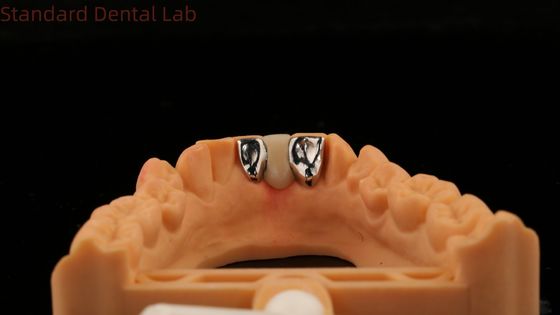 kaufen Dental PFM Maryland Bridge hohe Ästhetik FDA zertifiziert mit Vita Porzellan China Dental Lab on-line-Fertigung