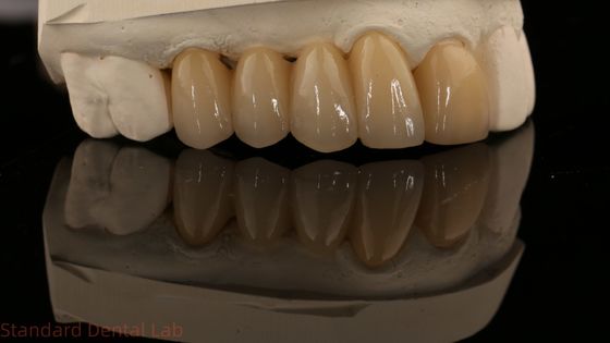 kaufen Noritake Porzellan Vollkontur Zirkonia Krone Hoch ästhetische Natürliche angepasste Zirkonia Zahnbrücke on-line-Fertigung