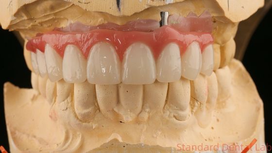 kaufen Gute Passform Präzise Ästhetik Zirkonia Porzellan Krone Rosa Porzellan mit Bleichschatten on-line-Fertigung