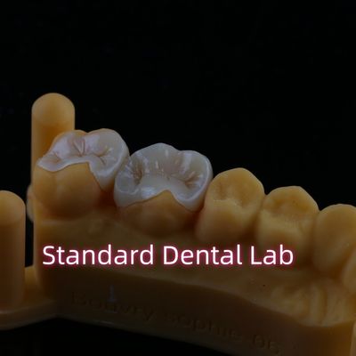 Zusammengesetztes Harz Zirkonia Emax Metall Inlay Onlay Overlay