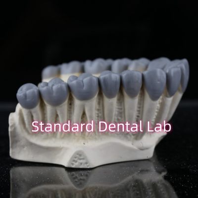 SDL Dental Lab Digitale Diagnose Wachs Up Crown Bridge