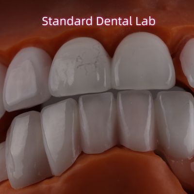 Lithium Dizilikat-Schicht Ivoclar Emax Zirkonia Laminat Veneers Durchsichtig OEM ODM
