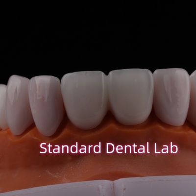 Durchsichtig Emax Zirkonia Laminat Veneers Porzellan Zahn Veneers Chemisch verystable