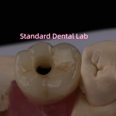 Hintere Implantatkrone Bruxier Massivzirkonie Schraube