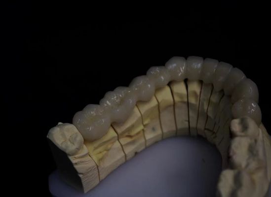 Zirkonium aus geschmolzenem Porzellan