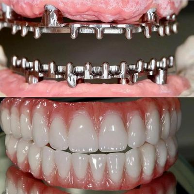 Dental Hybird Malo Implantate Brücke Professional Perfekt Fit FDA zertifiziert