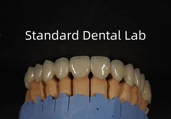 China Dental Lab Metall Keramikkrone PFM Krone hohe Ästhetik