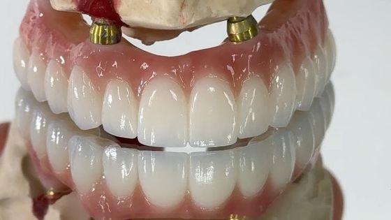 Dental All On X Implantat PFM Krone Titan Fixed Hybrid Prothese