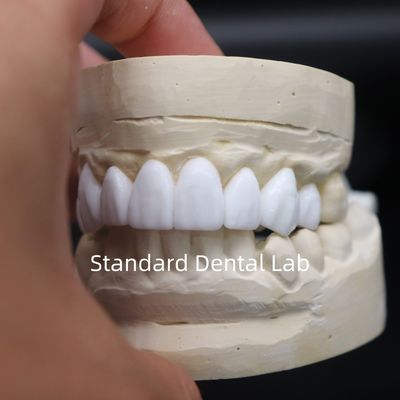 Zahnkronen Diagnostik-Wachs-up hohe Ästhetik aus China Zahnlabor