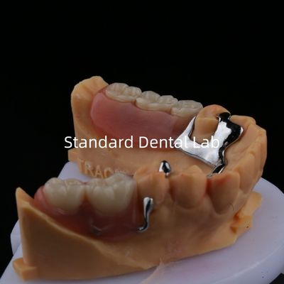 3 Form Exocad Laserdruck Niedrigguss Teilabschluss