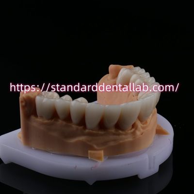 FDA High Esthetics Dental Zirkonia Brücke mit Schichten Porzellan Zirkonia Zahnkrone China Dental Lab