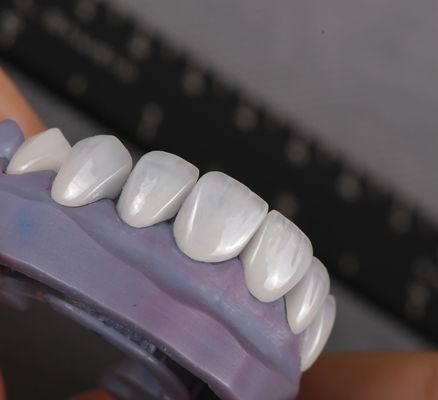 Natürlich aussehende Emax Veneers Krone Biokompatibilität Bleichschatten mit minimaler Vorbereitung
