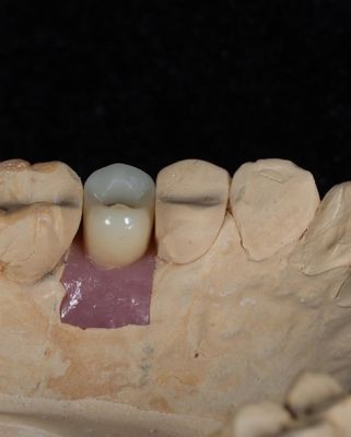 Schraubzement-Implantat für langlebige Zahnimplantate mit 5-jähriger Garantie