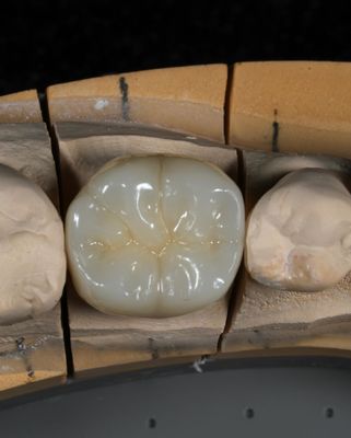 Vollkontur Zirkonia Krone Schnelle Umstellung für präzise und ästhetische Passform in 1 Woche