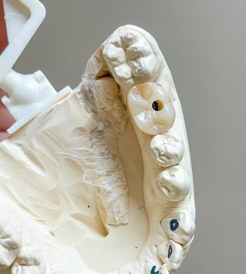 Schraubzement Implantat aufgehalten poliert Implantate gestützt Porzellanbrücke Vollbogen