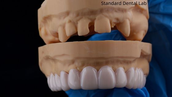 High Esthetics Dental Snap On Smile Standard Dental Lab Entfernbares Zahngerät