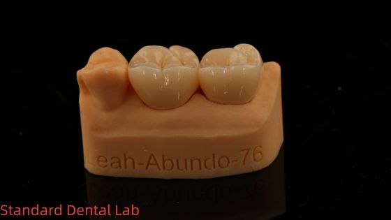 Solid Dental Lab Kronen 3D Pro Hochtransparenz Voll Zirkonia Kronen mit 5-Jahres Garantie