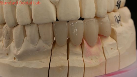 Solid Dental Lab Kronen 3D Pro Hochtransparenz Voll Zirkonia Kronen mit Vita Schatten angepasst