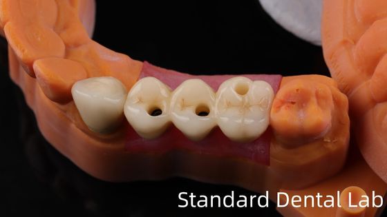 Professionelle Zirkonia Zahnimplantate Krone Titan CAD CAM Zirkonia Krone China Zahnlabor