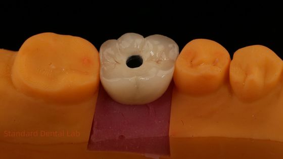 Schraubgehaltenes PFZ-Porzellan-Schichtzirkonia-Zahnimplantatkrone aus dem Zahnlabor ISO FDA CE-zertifiziert mit 5-jähriger Garantie