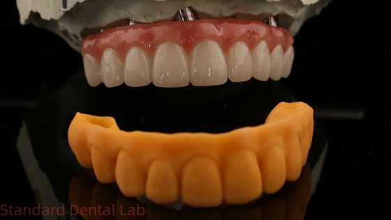 5 Jahre Garantie Zahnimplantat Krone PMMA Brücke über Multi-Einheit Abutments kundenspezifische Vita Schatten