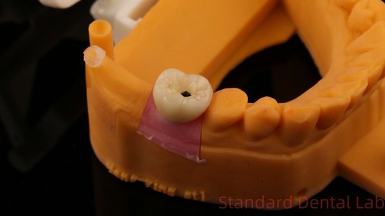 Dental Implantat Schraube Korone PFZ Porzellan Schicht Zirkonia mit 3D-Druck Modell