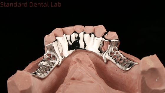 Kobalt-Chrom-Guss-Metall-Rahmen-Teilpräparate mit Untervorhang Design SDL Dental Lab