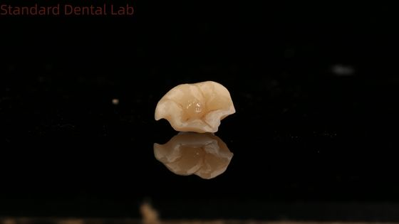Stärke Emax Keramikkrone Zahn-Onlay mit hervorragender Fleckenbeständigkeit China Dental Lab
