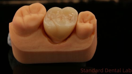 Vollzirkoniumkrone, China Zahnarztlabor schnelle Lieferung