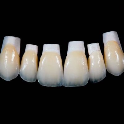 Hochtransparente Emax Porzellan Veneers Krone mit besseren Materialien von Ivoclar Vivadent