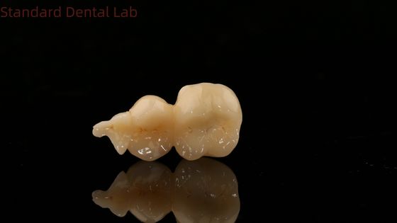 Zahnmedizinische digitale Zirkonie-Krone mit 3D-Druckmodell SDL Dental Lab Zirkonia Onlay