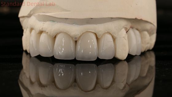 China Dental Lab Zirkonia Vollkontur Krone Hoch ästhetische natürliche Zahnbrücke 5 Jahre Garantie