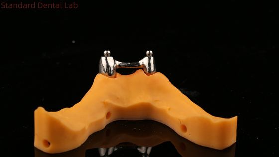 Ivoclar digitale Zahnimplantat-Stab-Zahnprothese mit Anhängen, Vollakryl-Titan-Zahnprothesen mit Implantatunterstützung