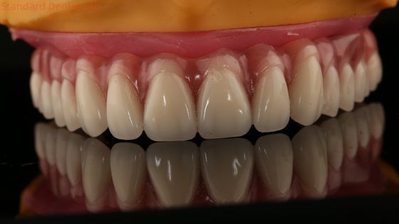 Akryl-Teilimplantat über den Zahnersatz Tizianiumbast vollständige Zahnersatz Zähne aufgestellt Schraube gehalten