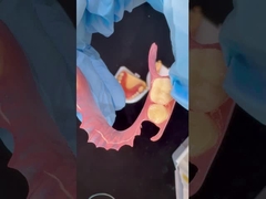 3D-Druckmodell hohe Ästhetik zahnärztliche TCS Valplast Flexible Teilpräparate zahnärztliches Labor